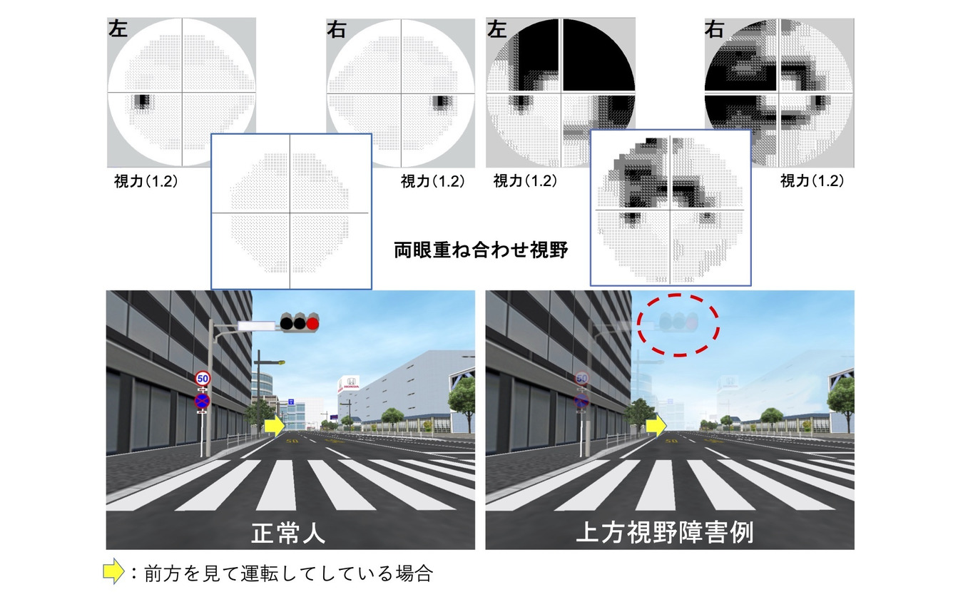 上は視野検査の結果。黒い部分が見えていない。左上は正常な人の視野（黒い部分は盲点。全員にある）。右上は、視野障害があり見えない部分が広がっている人の視野。二人ともそれぞれ、視力は1.2あるものの（免許更新に問題がない）、視野障害がある人の左右両眼を重ね合わせた視野は、ちょど信号を見るあたりが欠けているため、実際には信号そのものが消えて見える。