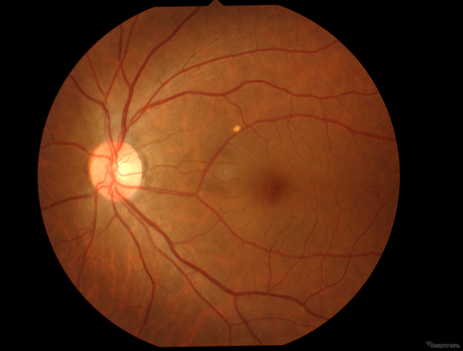 検査したときに撮影した私の左目の眼底写真。緑内障だとこの写真で神経の異常がわかる。