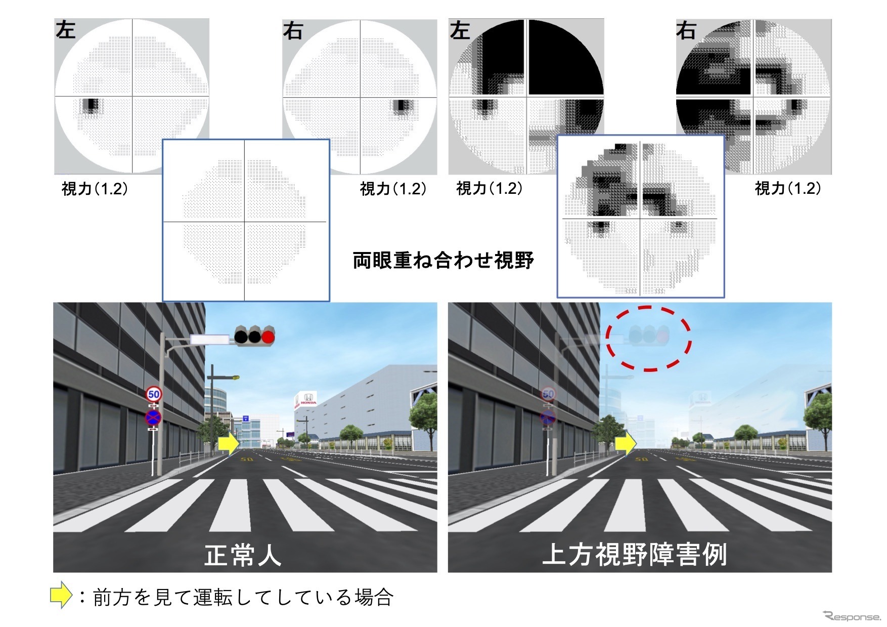 上は視野検査の結果。黒い部分が見えていない。左上は正常な人の視野（黒い部分は盲点。全員にある）。右上は、視野障害があり見えない部分が広がっている人の視野。二人ともそれぞれ、視力は1.2あるものの（免許更新に問題がない）、視野障害がある人の左右両眼を重ね合わせた視野は、ちょど信号を見るあたりが欠けているため、実際には信号そのものが消えて見える。