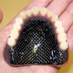 カーボン繊維強化型入れ歯